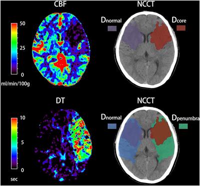 Early Edema Within the Ischemic Core Is Time-Dependent and Associated With Functional Outcomes of Acute Ischemic Stroke Patients